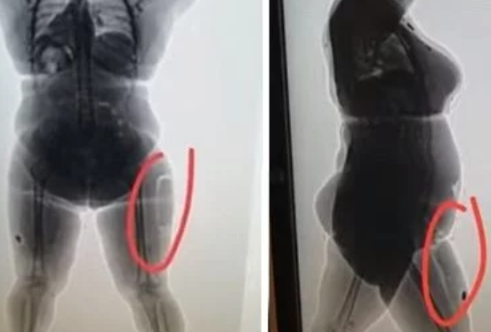 Colombia: detuvieron a una mujer que tenía cocaína líquida implantada en los muslos para transportarla a España 