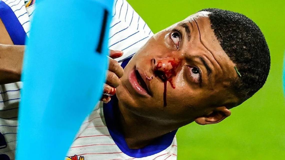 Mbappé se fracturó el tabique en el triunfo de Francia ante Austria por la Eurocopa