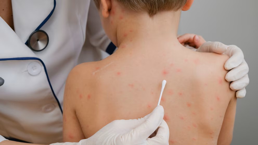 El instituto Malbrán confirmó el primer caso de sarampión del año en Argentina